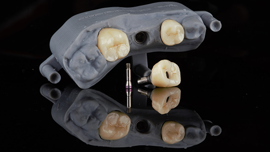 titanium Implants